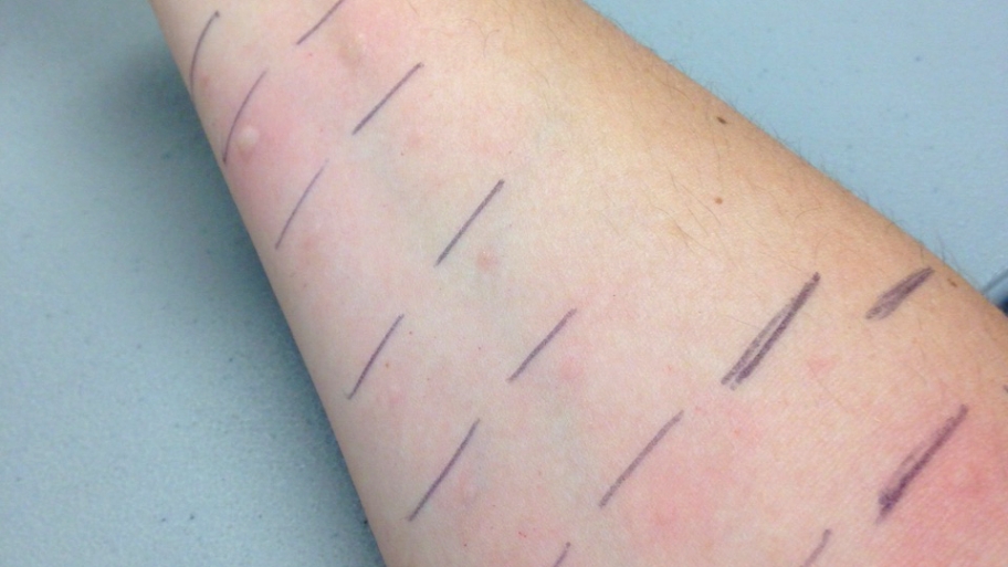 a man's arm after allergy testing